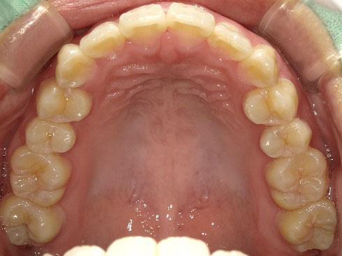 マウスピース矯正の治療後