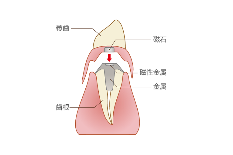 磁性アタッチメント義歯